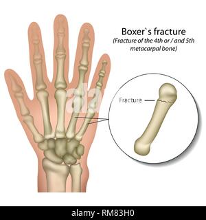 Boxer`s bone hand fracture medical vector illustration Stock Vector